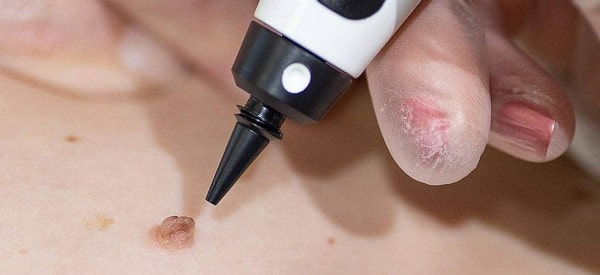 After Skin Tag Removal Lytham St Anne's