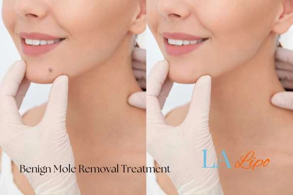 Before-and-after results following benign mole-removal treatment Lytham St Anne's