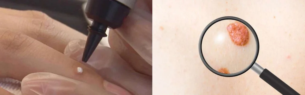 CryoPen practitioner Lytham St Anne's assessing a benign mole before treatment