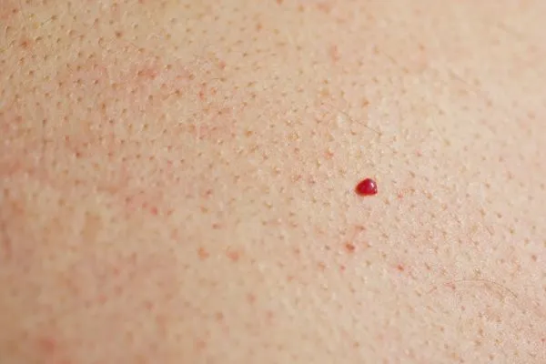 close up of a cherry angioma Lytham St Anne's