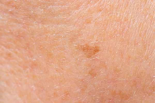 close up picture of age spots Lytham St Anne's