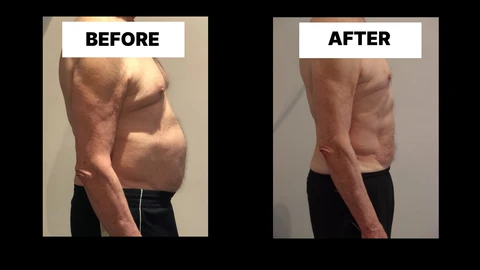 What Symptoms Can Diastasis Recti Cause in Men? Weak Core, Back Pain and Poor Posture Lytham St Anne's
